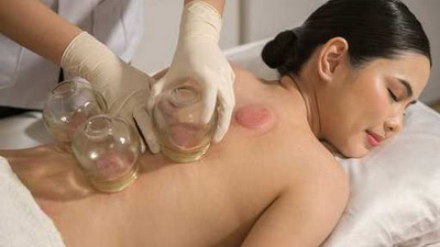 A person receiving cupping therapy at a massage therapy Ottawa clinic lies on a massage table. Three glass cups are placed on their back, leaving visible marks on the skin.